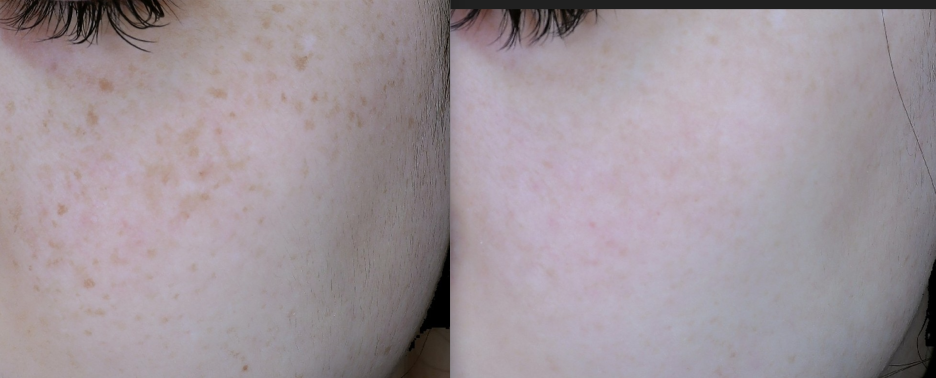 피부의 두 개의 부분 비교, 왼쪽은 점이 있는 피부, 오른쪽은 매끄럽고 결점이 적은 피부.
